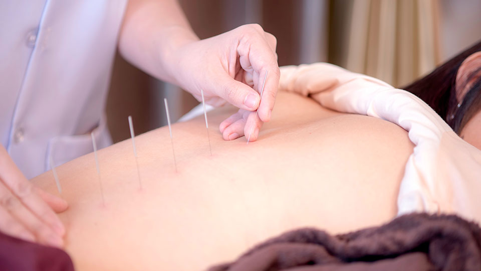 Close up on practitioner applying acupuncture needles along someone's spine